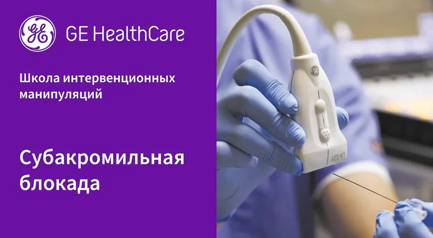 Субакромильная блокада