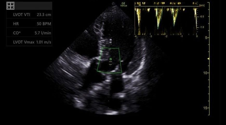 Speeding up VTI Fluid Responsiveness Assessments