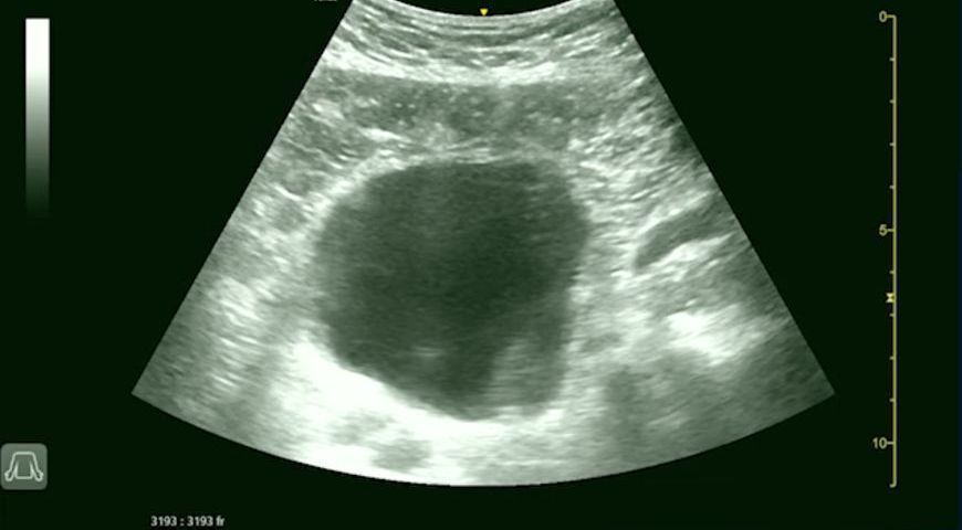 How To Ultrasound The Abdominal Aorta & Femoral Vein