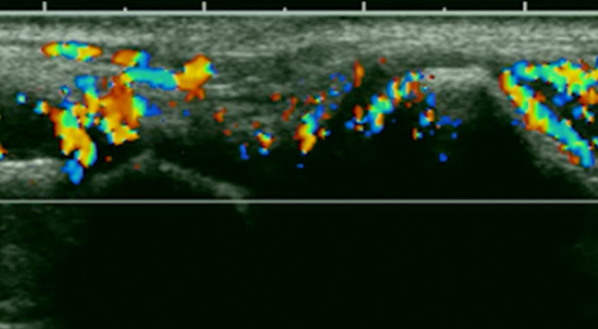Why Use Ultrasound For Quantitative Scoring Of Synovitis