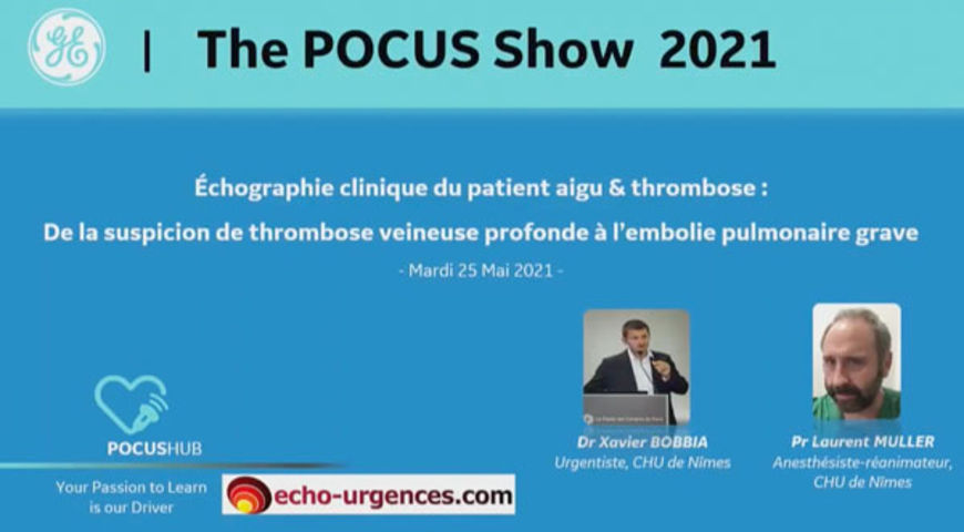 Echographie clinique du patient aigu & thrombose :  De la suspicion de thrombose veineuse prodonde à l'embolie pulmonaire grave