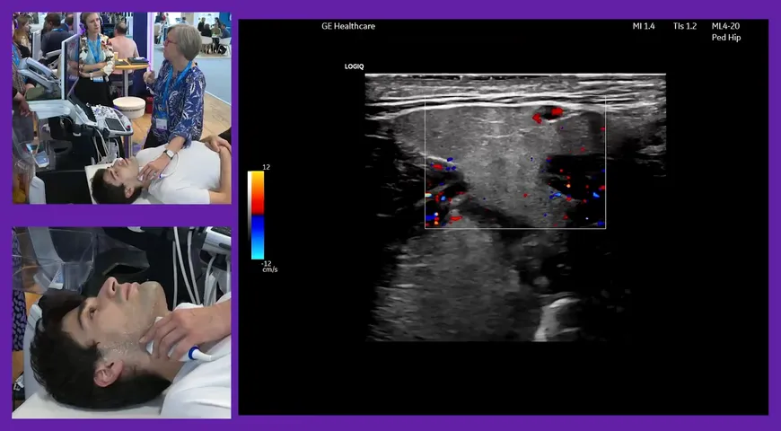 Tips, tricks, and must haves when scanning the salivary gland and Lacrimal gland with Prof. Lene Terslev