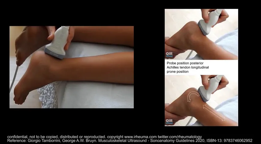 Ultrasound of the Achilles tendon