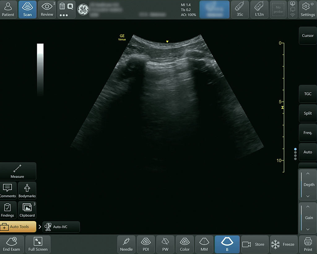 A deep view at the lower anterior point with the pleura centered in the image