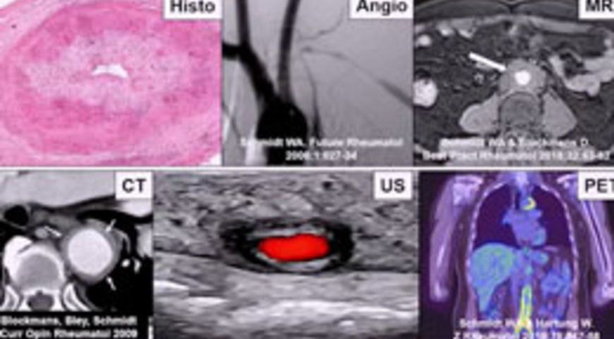 Fast Track US in Giant Cell Arteritis