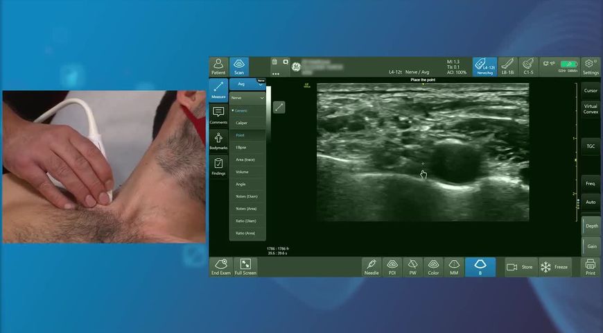 Interscalene Block with Dr Amit Pawa