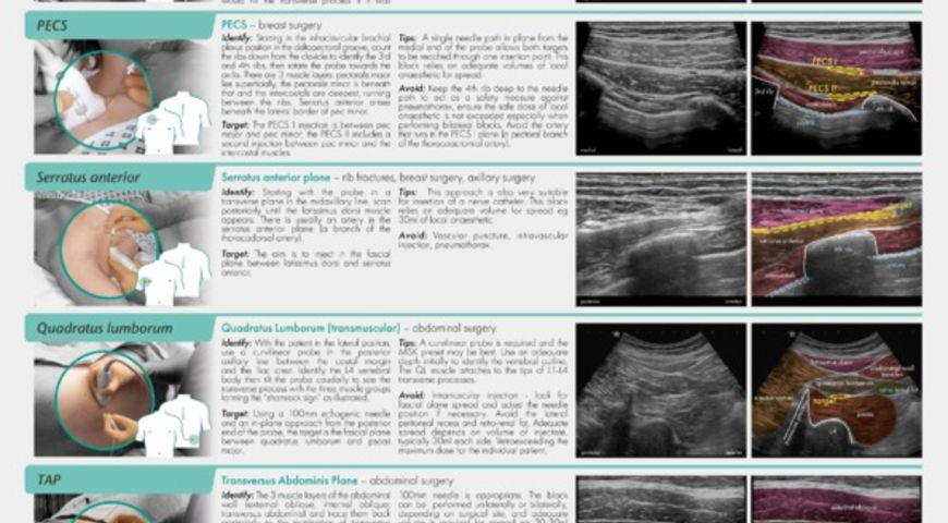 Regional Anaesthesia For Trunk