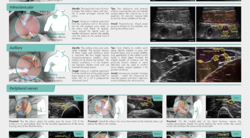 Regional Anaesthesia For Upper Limb
