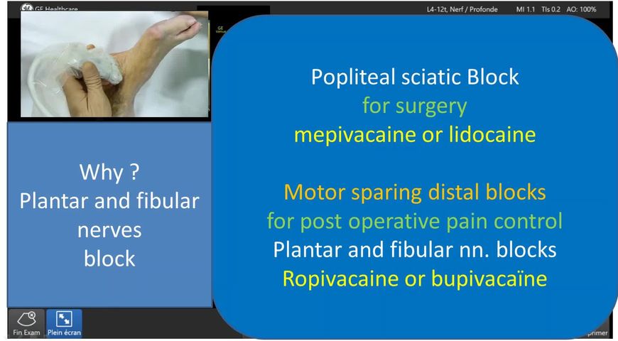 Ultrasound guided plantar and peroneal nerves blocks for analgesia after hallux valgus surgery: Learn why and how to perform these distal blocks for forefoot surgery.