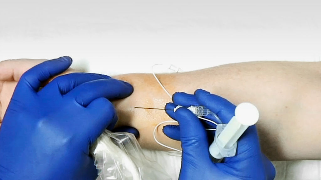 The initial puncture point is located directly above the median nerve proximal to the wrist crease