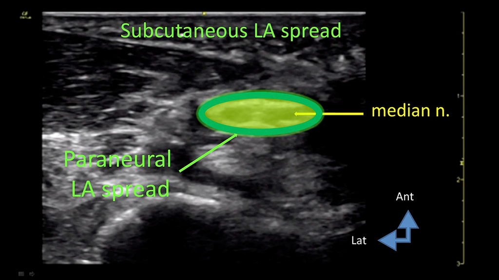 Substaneous LA spread