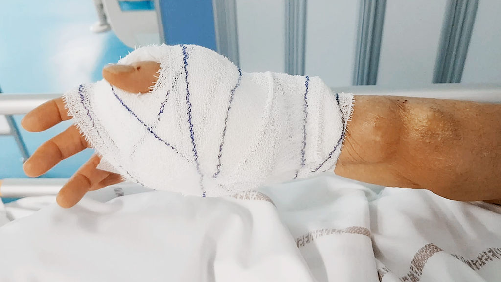 Ultrasound-guided tumescent anesthesia