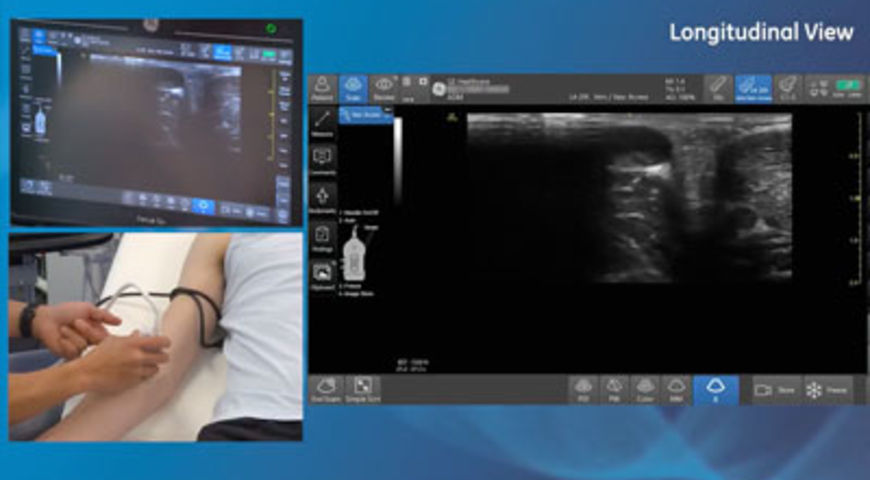 Upper Extremity Vascular Access